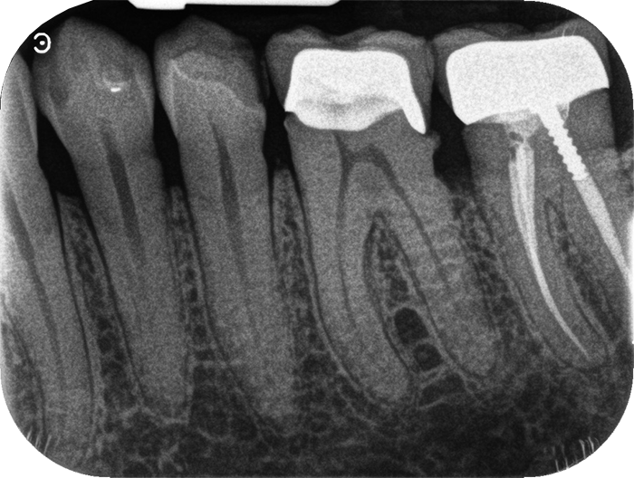 Traitements endodontique DR Agnes Simon, chirurgien dentiste