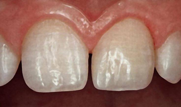 Composite, DR Agnes Simon chirurgien-dentiste