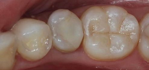 Composite, DR Agnes Simon chirurgien-dentiste