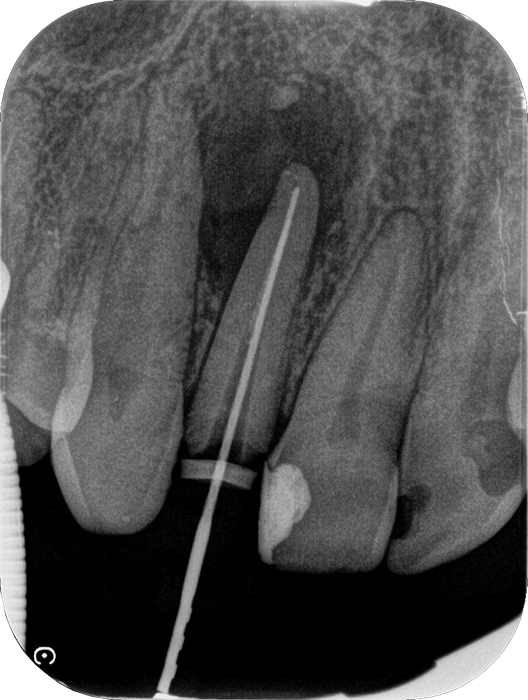 Traitements endodontique DR Agnes Simon, chirurgien dentiste