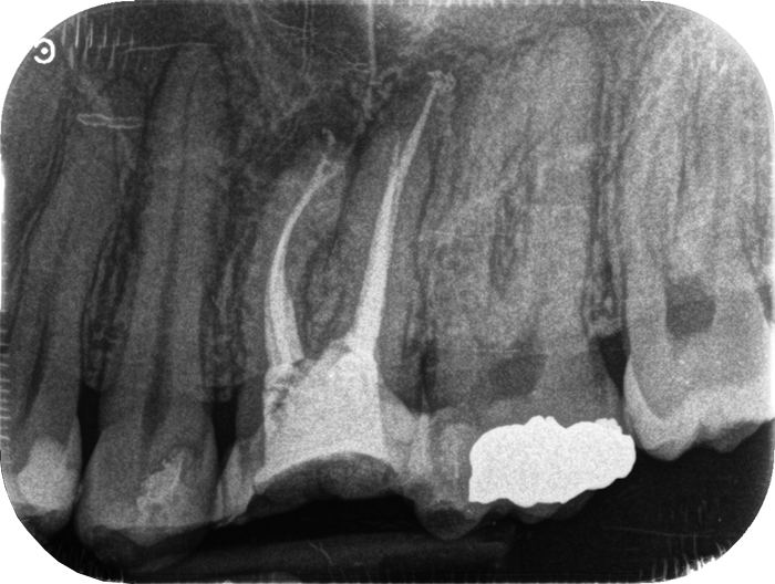 Traitements endodontique DR Agnes Simon, chirurgien dentiste