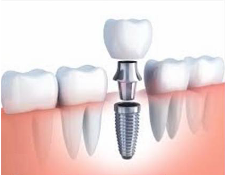 Prothèse dentaire implant dentaire DR Agnès Simon chirurgien dentiste