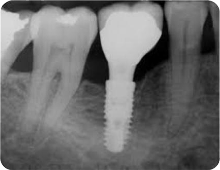 Prothèse dentaire implant dentaire DR Agnès Simon chirurgien dentiste