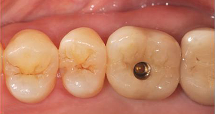 Prothèse dentaire implant dentaire DR Agnès Simon chirurgien dentiste