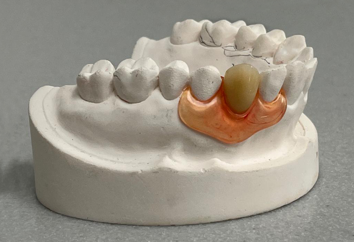 Prothèse transitoire DR Agnès Simon chirurgien dentiste